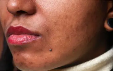 Hyperpigmentation - Face 0