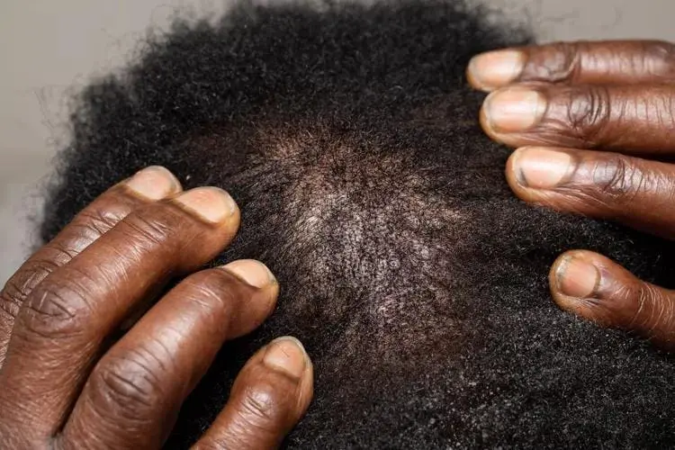 Hair Loss