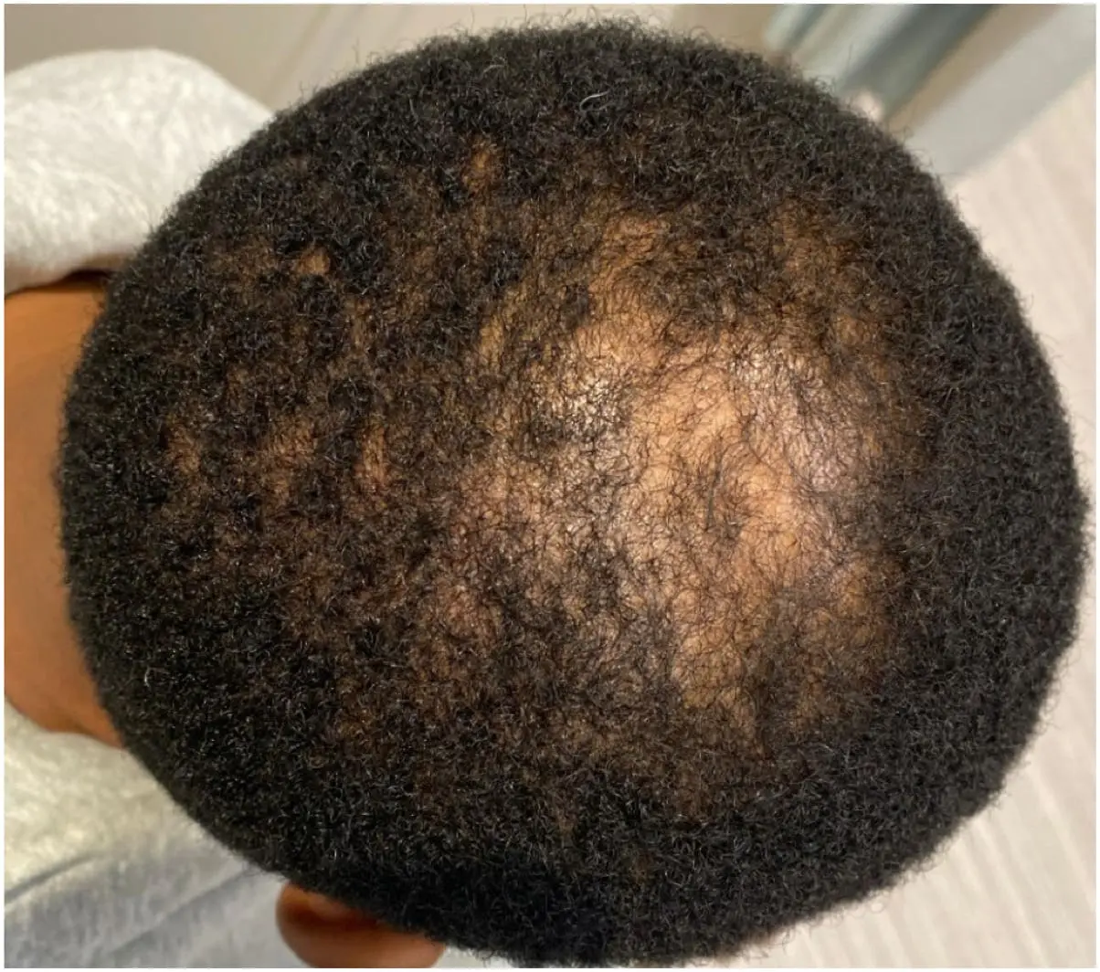 main with hair loss(balding head)